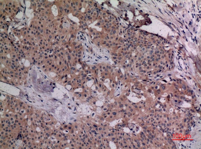 Fig.2. Immunohistochemical analysis of paraffin-embedded human-breast-cancer, antibody was diluted at 1:100.