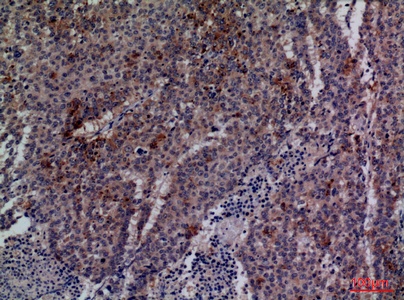 Fig.3. Immunohistochemical analysis of paraffin-embedded human-lung-cancer, antibody was diluted at 1:100.