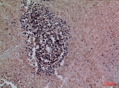 Fig.2. Immunohistochemical analysis of paraffin-embedded human-lung-cancer, antibody was diluted at 1:100.