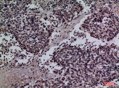 Fig.3. Immunohistochemical analysis of paraffin-embedded human-lung-cancer, antibody was diluted at 1:100.