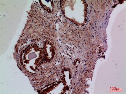 Fig.2. Immunohistochemical analysis of paraffin-embedded human-prostate-cancer, antibody was diluted at 1:100.