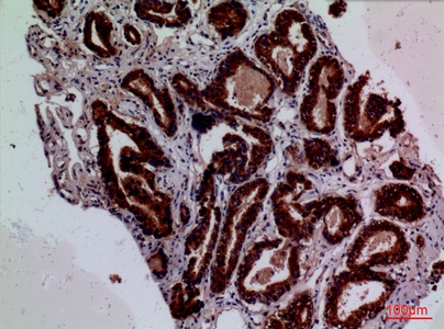 Fig.3. Immunohistochemical analysis of paraffin-embedded human-prostate-cancer, antibody was diluted at 1:100.