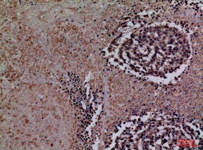 Fig.4. Immunohistochemical analysis of paraffin-embedded human-lung-cancer, antibody was diluted at 1:100.