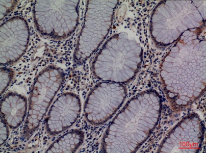 Fig.2. Immunohistochemical analysis of paraffin-embedded human-colon-cancer, antibody was diluted at 1:100.