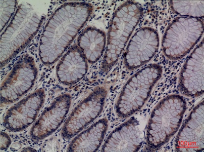 Fig.3. Immunohistochemical analysis of paraffin-embedded human-colon-cancer, antibody was diluted at 1:100.