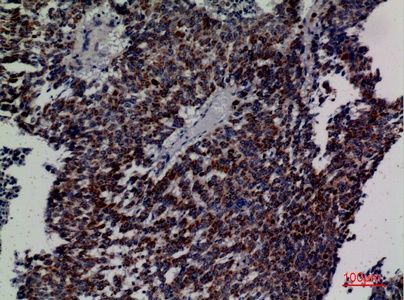 Fig.3. Immunohistochemical analysis of paraffin-embedded human-lung-cancer, antibody was diluted at 1:100.