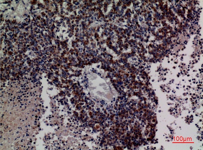 Fig.4. Immunohistochemical analysis of paraffin-embedded human-lung-cancer, antibody was diluted at 1:100.