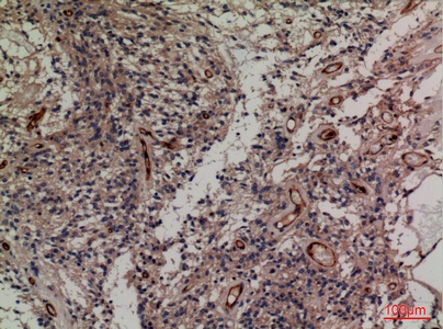 Fig.2. Immunohistochemical analysis of paraffin-embedded human-ovary-cancer, antibody was diluted at 1:100.