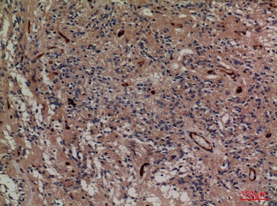 Fig.3. Immunohistochemical analysis of paraffin-embedded human-ovary-cancer, antibody was diluted at 1:100.
