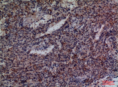 Fig.2. Immunohistochemical analysis of paraffin-embedded human-lung-cancer, antibody was diluted at 1:100.