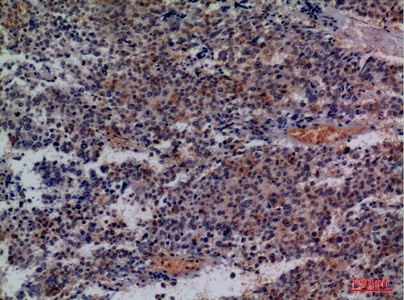 Fig.3. Immunohistochemical analysis of paraffin-embedded human-lung-cancer, antibody was diluted at 1:100.