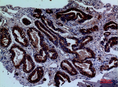 Fig.2. Immunohistochemical analysis of paraffin-embedded human-prostate-cancer, antibody was diluted at 1:100.