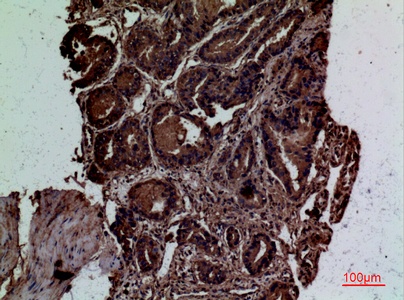 Fig.2. Immunohistochemical analysis of paraffin-embedded human-prostate-cancer, antibody was diluted at 1:100.
