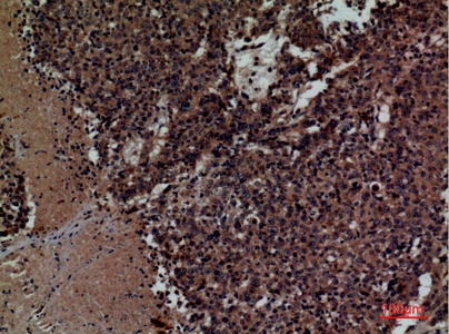 Fig.2. Immunohistochemical analysis of paraffin-embedded human-lung-cancer, antibody was diluted at 1:100.