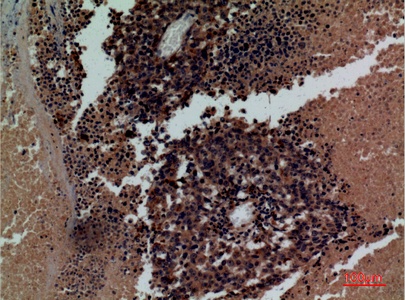 Fig.3. Immunohistochemical analysis of paraffin-embedded human-lung-cancer, antibody was diluted at 1:100.
