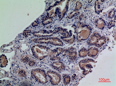 Fig.4. Immunohistochemical analysis of paraffin-embedded human-prostate-cancer, antibody was diluted at 1:100.