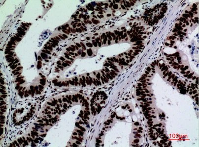 Fig.2. Immunohistochemical analysis of paraffin-embedded human-colon-cancer, antibody was diluted at 1:100.