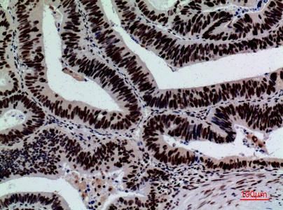 Fig.3. Immunohistochemical analysis of paraffin-embedded human-colon-cancer, antibody was diluted at 1:100.