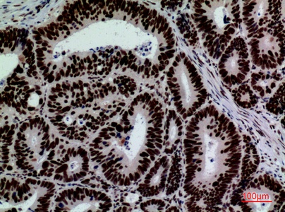 Fig.4. Immunohistochemical analysis of paraffin-embedded human-colon-cancer, antibody was diluted at 1:100.