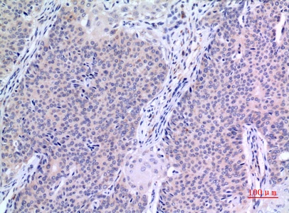 Fig.2. Immunohistochemical analysis of paraffin-embedded human-mammary-cancer, antibody was diluted at 1:100.