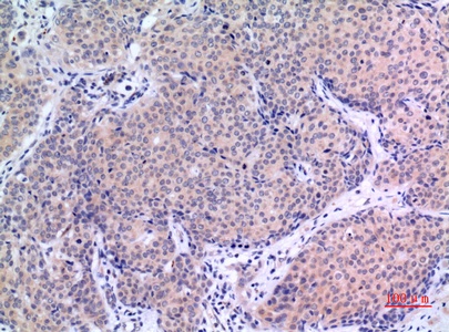 Fig.3. Immunohistochemical analysis of paraffin-embedded human-mammary-cancer, antibody was diluted at 1:100.