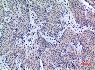 Fig.2. Immunohistochemical analysis of paraffin-embedded human-mammary-cancer, antibody was diluted at 1:100.