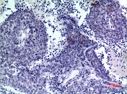 Fig.3. Immunohistochemical analysis of paraffin-embedded human-lung-cancer, antibody was diluted at 1:100.