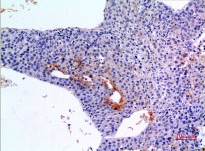 Fig.3. Immunohistochemical analysis of paraffin-embedded human-liver-cancer, antibody was diluted at 1:100.
