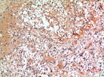 Fig.2. Immunohistochemical analysis of paraffin-embedded human-oophoroma, antibody was diluted at 1:100.