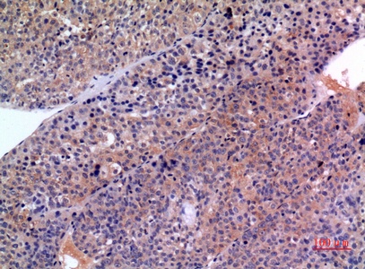 Fig.2. Immunohistochemical analysis of paraffin-embedded human-liver-cancer, antibody was diluted at 1:100.