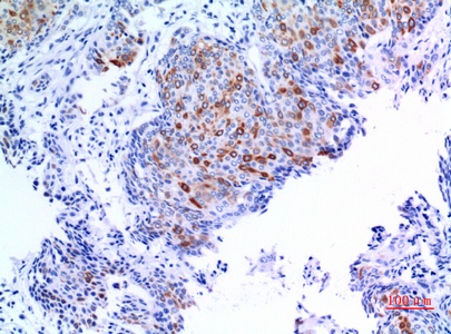 Fig.3. Immunohistochemical analysis of paraffin-embedded human-mammary-cancer, antibody was diluted at 1:100.