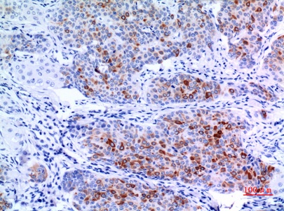 Fig.4. Immunohistochemical analysis of paraffin-embedded human-mammary-cancer, antibody was diluted at 1:100.