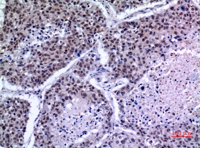 Fig.2. Immunohistochemical analysis of paraffin-embedded human-lung, antibody was diluted at 1:100.