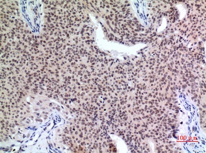 Fig.2. Immunohistochemical analysis of paraffin-embedded human-mammary-cancer, antibody was diluted at 1:100.