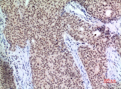 Fig.3. Immunohistochemical analysis of paraffin-embedded human-mammary-cancer, antibody was diluted at 1:100.