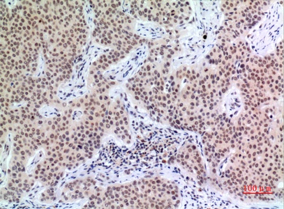 Fig.4. Immunohistochemical analysis of paraffin-embedded human-mammary-cancer, antibody was diluted at 1:100.