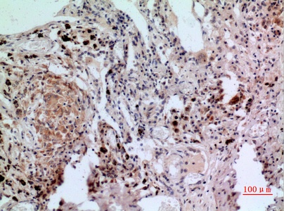 Fig.2. Immunohistochemical analysis of paraffin-embedded human-lung, antibody was diluted at 1:100.