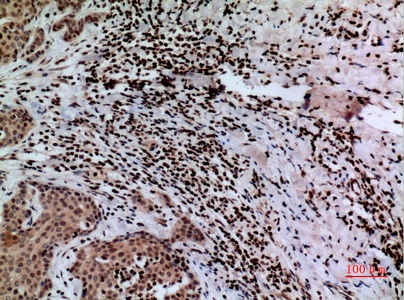 Fig.2. Immunohistochemical analysis of paraffin-embedded human-mammary-cancer, antibody was diluted at 1:100.