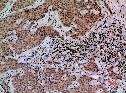 Fig.3. Immunohistochemical analysis of paraffin-embedded human-mammary-cancer, antibody was diluted at 1:100.