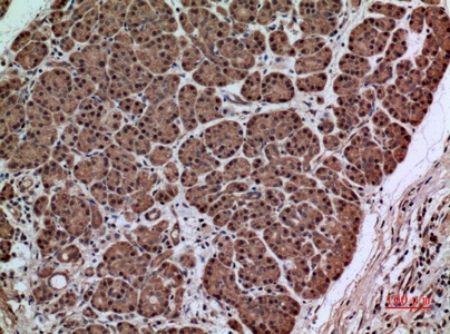 Fig.4. Immunohistochemical analysis of paraffin-embedded human-pancreas-cancer, antibody was diluted at 1:100.