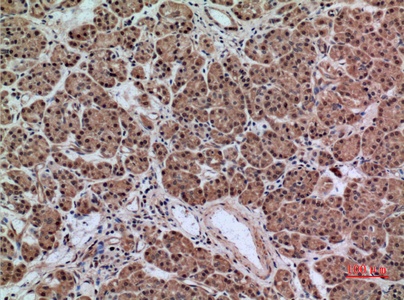 Fig.5. Immunohistochemical analysis of paraffin-embedded human-pancreas-cancer, antibody was diluted at 1:100.