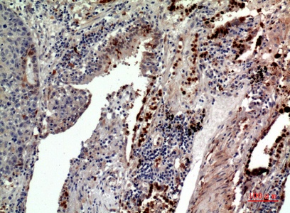 Fig.4. Immunohistochemical analysis of paraffin-embedded human-lung, antibody was diluted at 1:100.