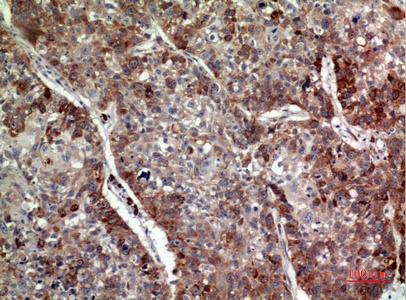 Fig.2. Immunohistochemical analysis of paraffin-embedded human-lung, antibody was diluted at 1:100.