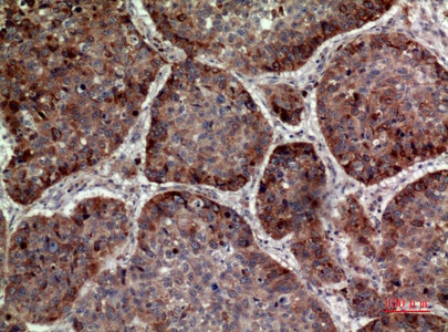 Fig.3. Immunohistochemical analysis of paraffin-embedded human-lung, antibody was diluted at 1:100.