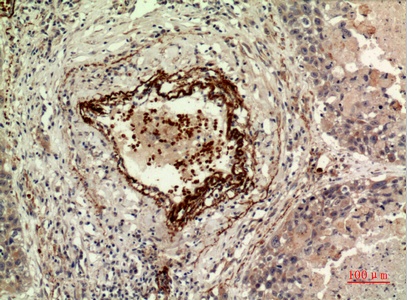 Fig.2. Immunohistochemical analysis of paraffin-embedded human-lung, antibody was diluted at 1:100.