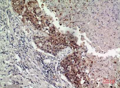 Fig.2. Immunohistochemical analysis of paraffin-embedded human-lung, antibody was diluted at 1:100.