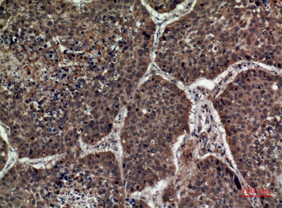 Fig.4. Immunohistochemical analysis of paraffin-embedded human-lung, antibody was diluted at 1:100.
