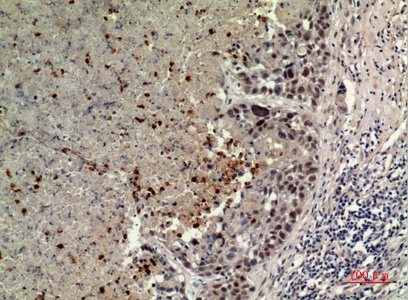 Fig.2. Immunohistochemical analysis of paraffin-embedded human-lung, antibody was diluted at 1:100.