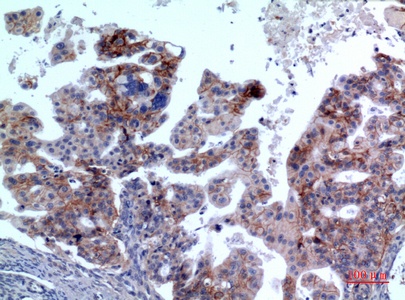 Fig.2. Immunohistochemical analysis of paraffin-embedded human-Ovarian-cancer, antibody was diluted at 1:100.