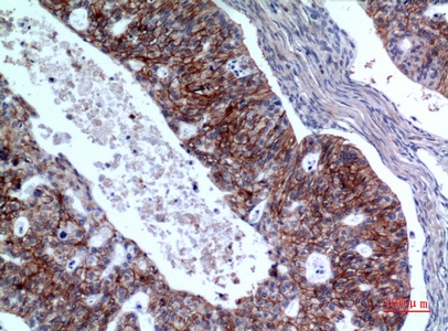 Fig.3. Immunohistochemical analysis of paraffin-embedded human-Ovarian-cancer, antibody was diluted at 1:100.